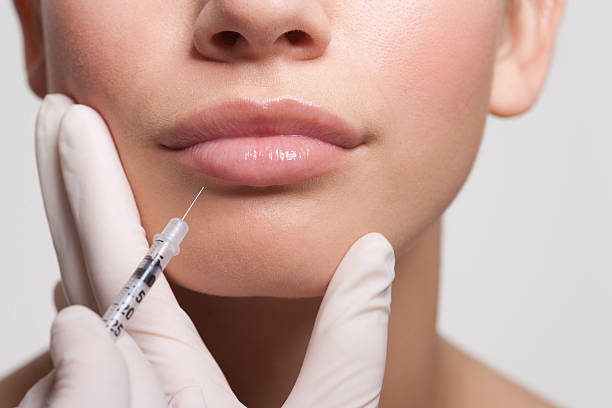 une injection d’acide hyaluronique labial